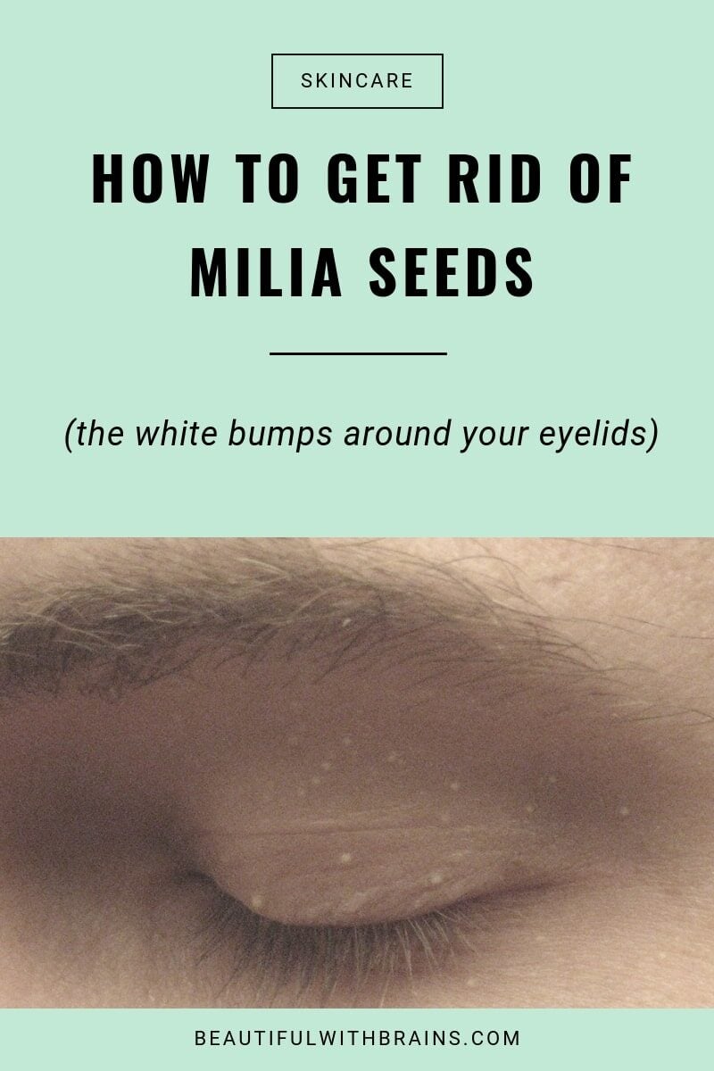 how to prevent, treat and remove milia seeds