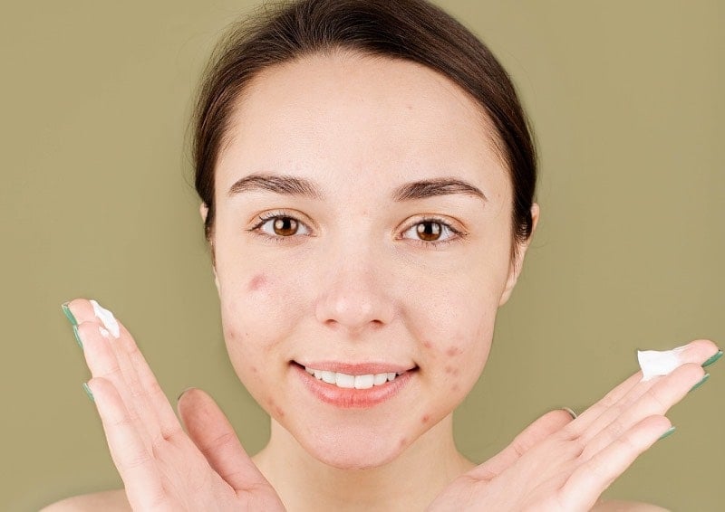 Salicylic Acid vs Azelaic Acid to treat acne